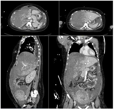 Liver Bleeding Due to HELLP Syndrome Treated With Embolization and Liver Transplantation: A Case Report and Review of the Literature